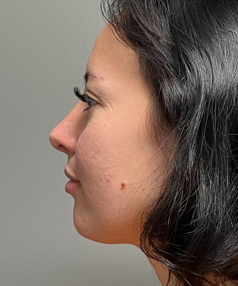 Rhinoplasty Before & After Image
